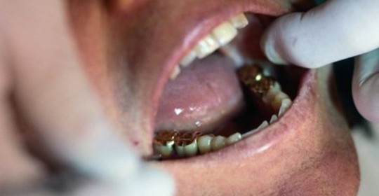 Le otturazioni dentali in amalgama sono nocive?